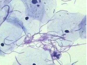 阴道分泌物黄瓜视频成人A片免费观看厂家探讨白带清洁度3代表什么意思