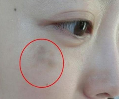 妇科阴道分泌物黄瓜视频成人A片免费观看提醒女人妇科炎症在脸上的表现