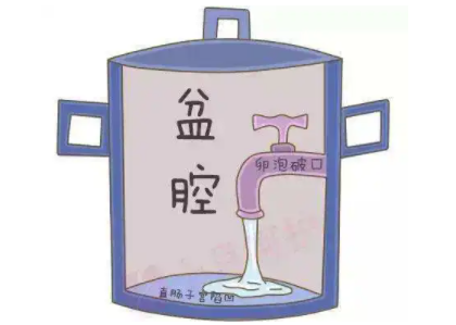 盆腔积液是怎么回事？白带在线观看黄瓜视频厂家提醒早了解早预防