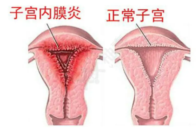 全自动阴道分泌物黄瓜视频成人A片免费观看厂家子宫内膜炎的症状表现提前了解与预防