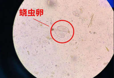 阴道分泌物黄瓜视频成人A片免费观看警惕外阴绕虫病易在儿童身上出现