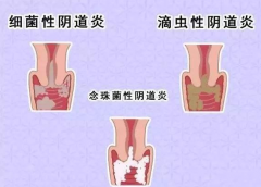 全自动阴道分泌物黄瓜视频成人A片免费观看厂家提醒您还在拖延吗，还在等阴道炎自愈吗？